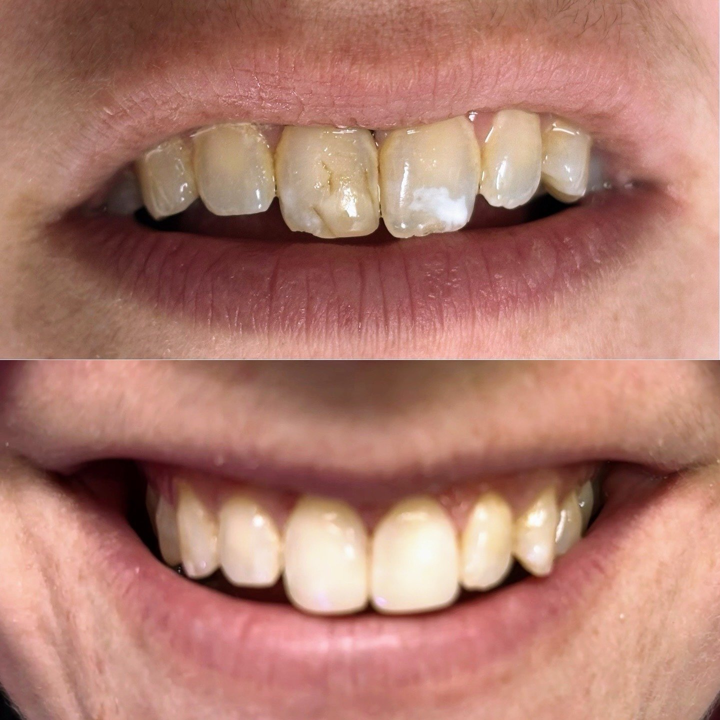Before and after smile view showing restoration of the upper front teeth by Dr. Florina Menina at Star Dental