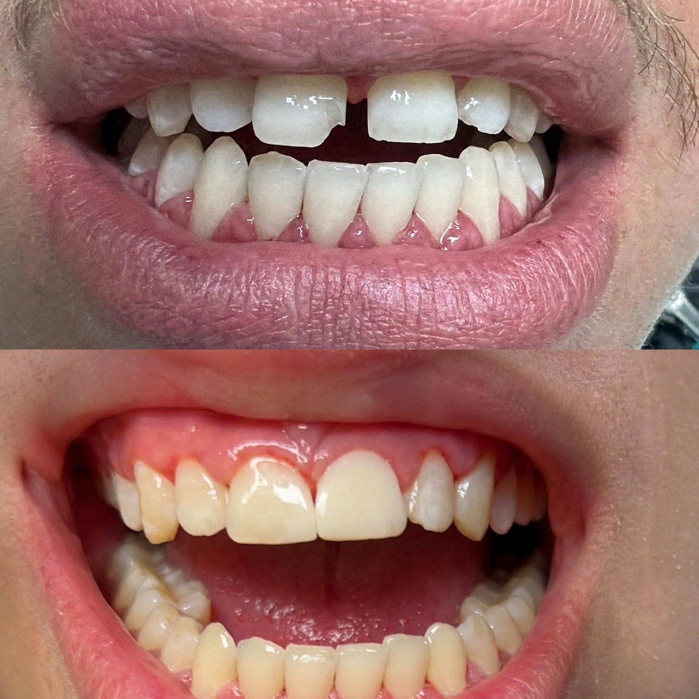 Before and after smile view showing broken upper front teeth restored by Dr. Florina Menina