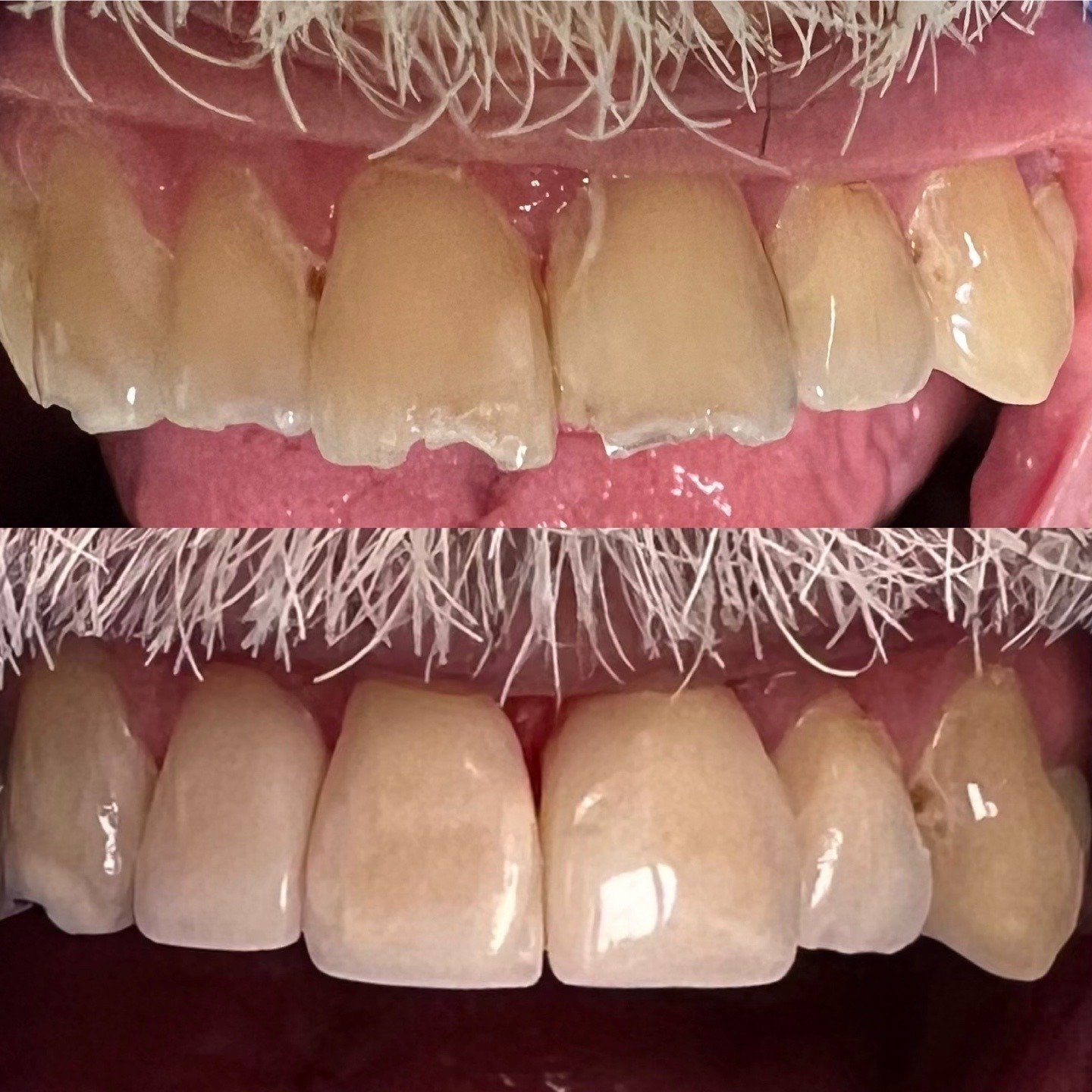 Before and after close-up showing restoration of chipped upper front-tooth edges by Dr. Florina Menina