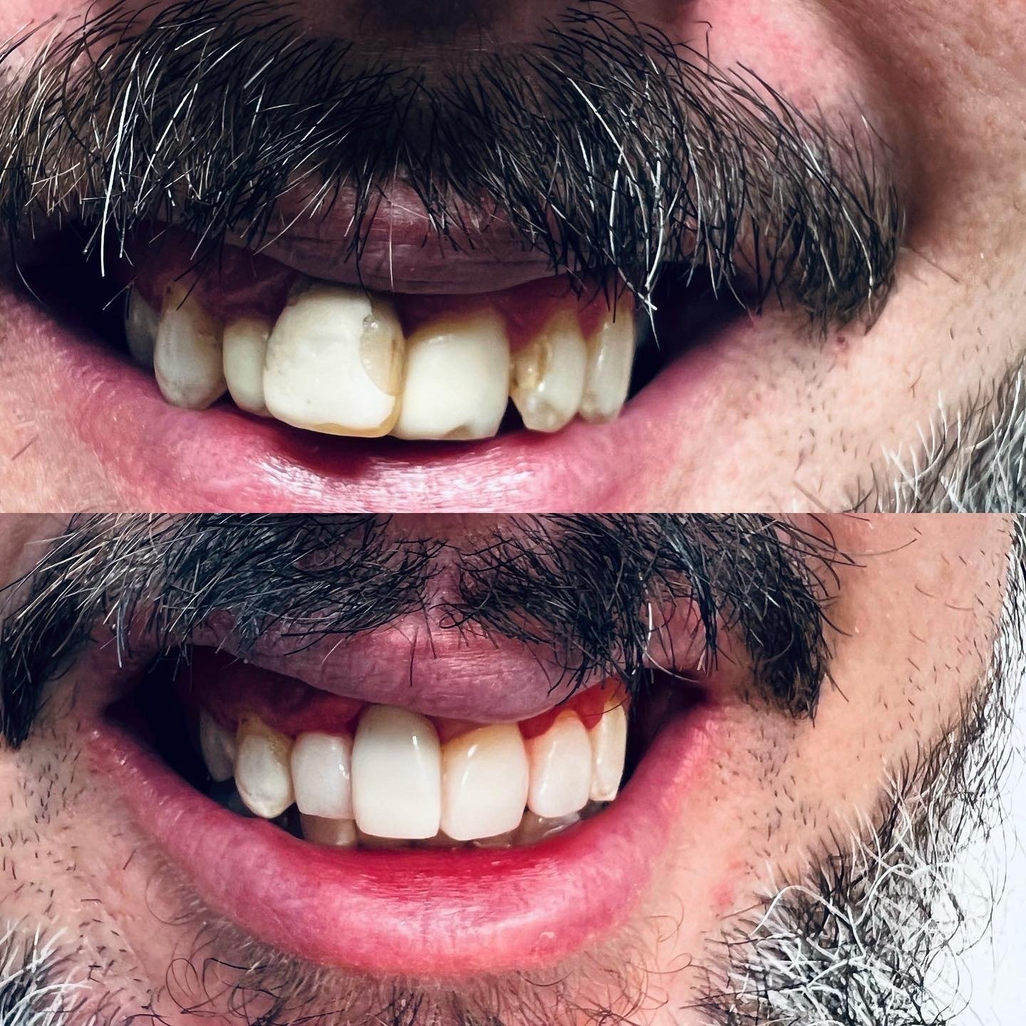 Before and after smile view showing an extensive upper front-teeth restoration by Dr. Florina Menina