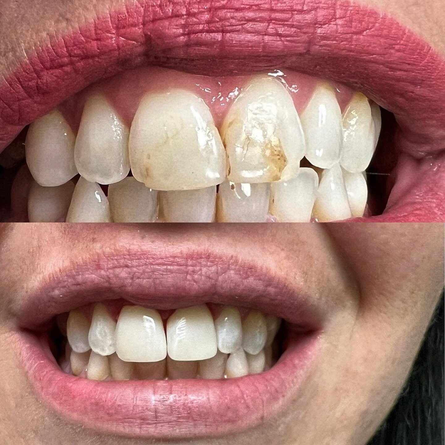 Before and after smile view showing restoration of a visibly discolored upper front tooth by Dr. Florina Menina