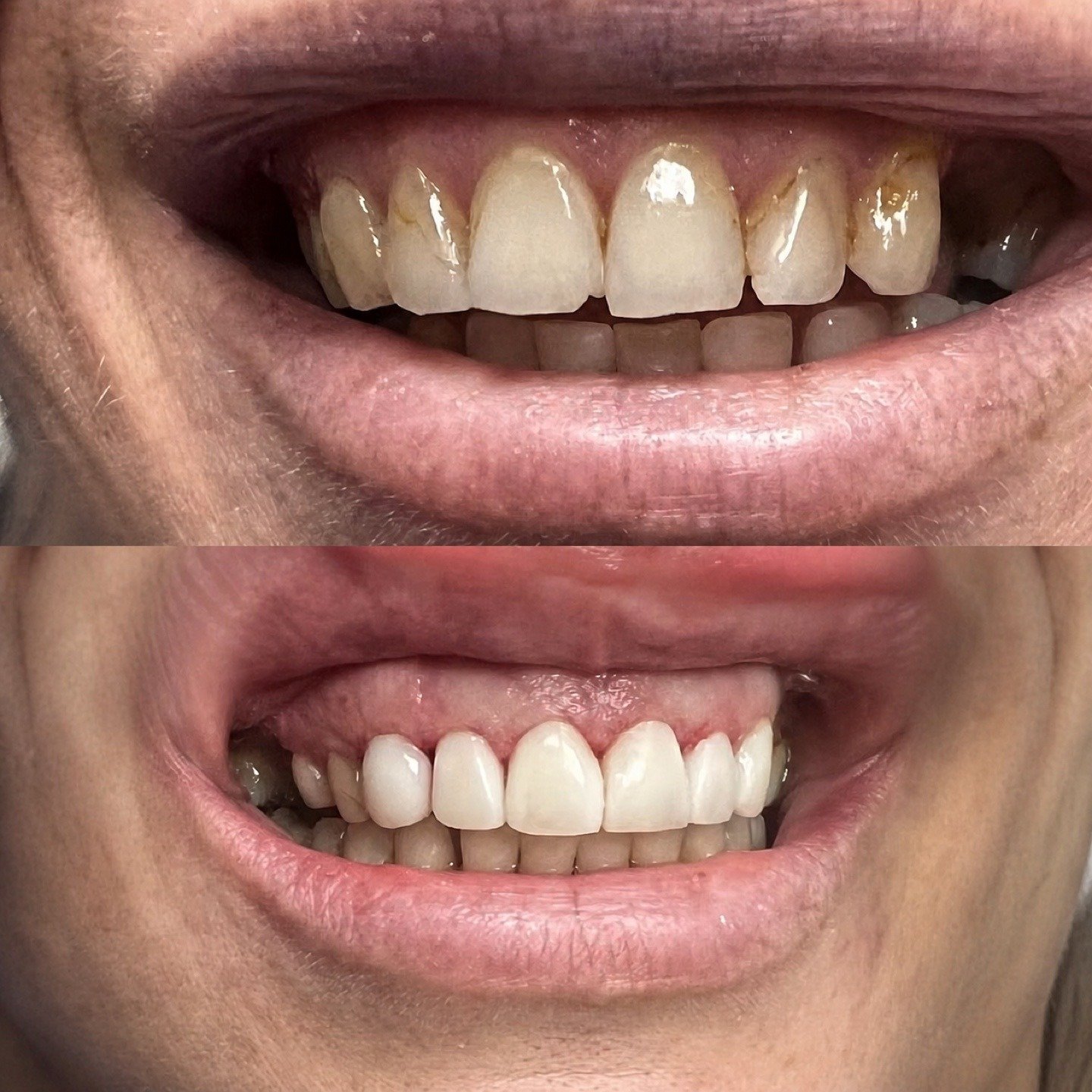 Before and after smile photographs showing restored upper front teeth by Dr. Florina Menina at Star Dental