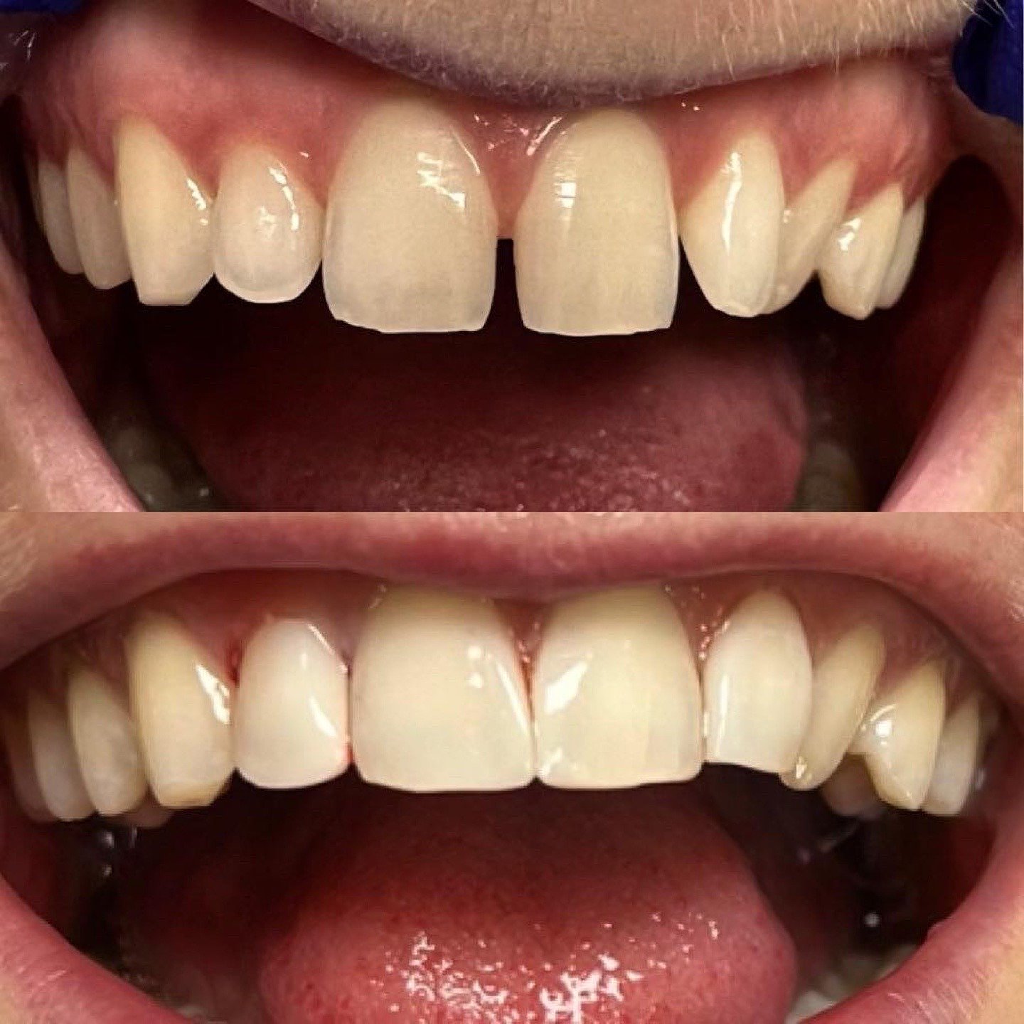 Before and after front view showing a small upper front-tooth gap restored by Dr. Florina Menina