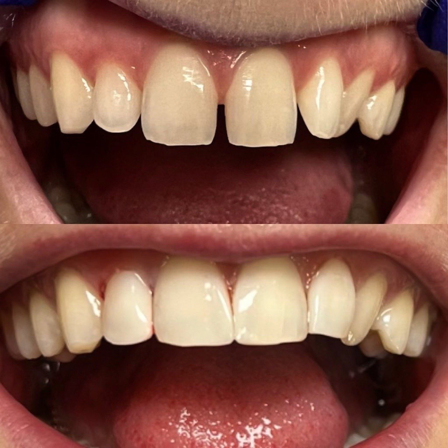 Side-angle before and after photographs showing restoration of an upper front-tooth gap by Dr. Florina Menina