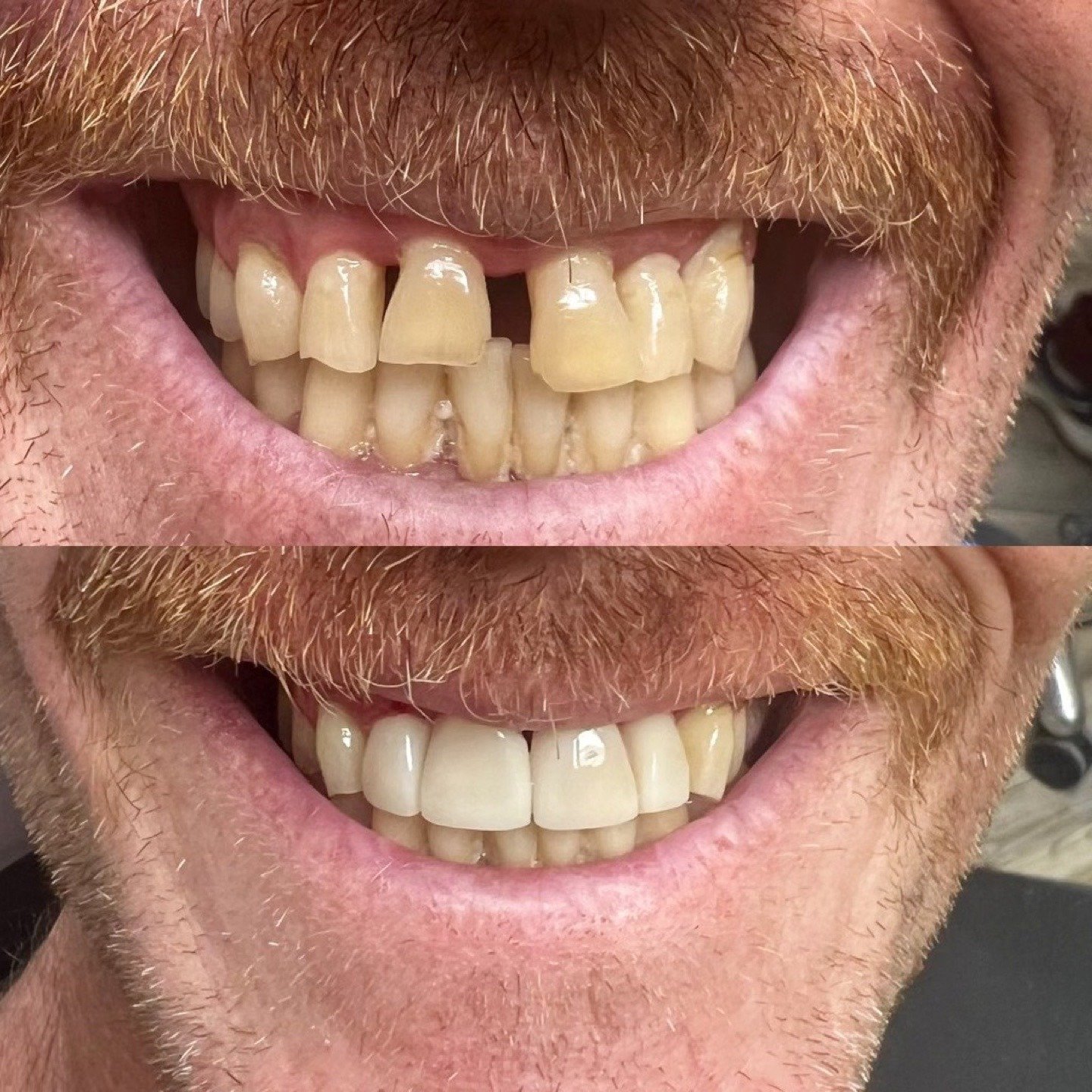 Before and after smile view showing restoration of a visible upper-front-tooth gap by Dr. Florina Menina