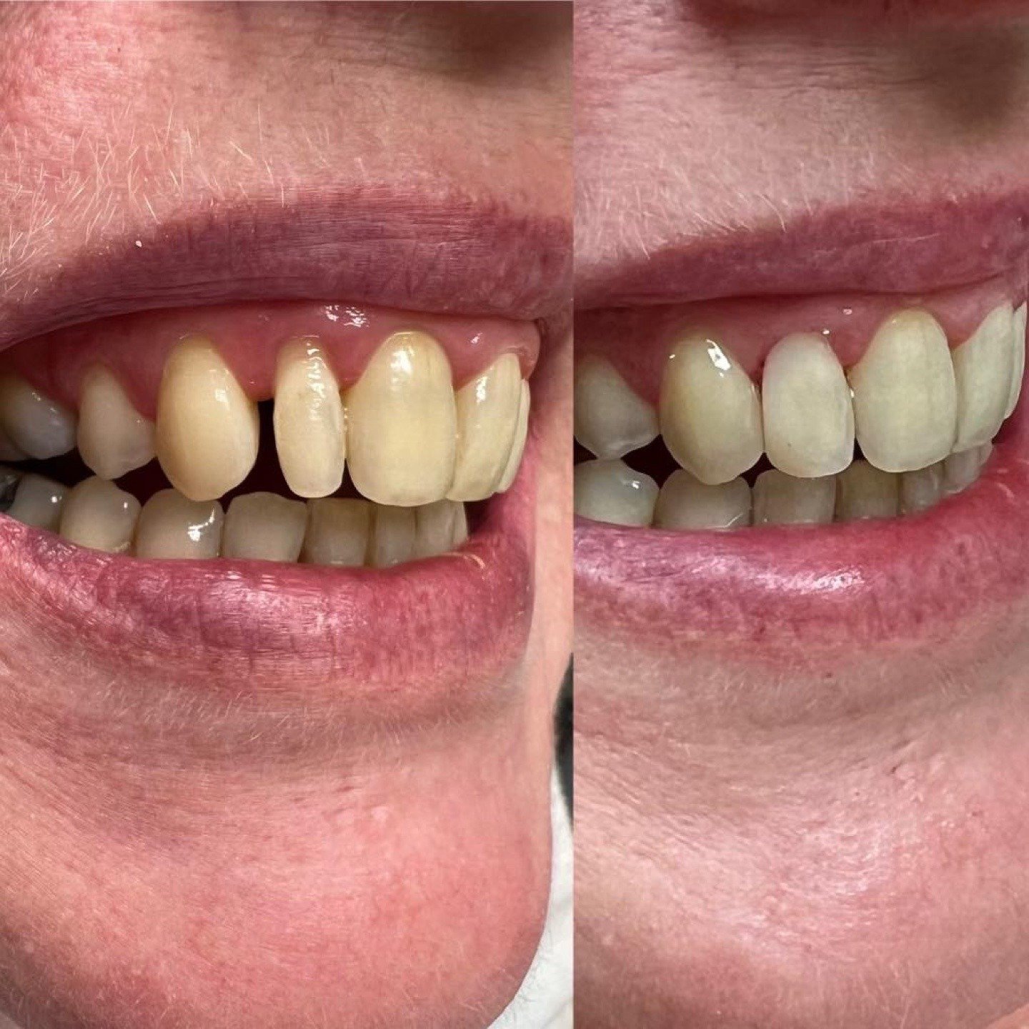 Side-view before and after photographs showing restored upper front teeth by Dr. Florina Menina