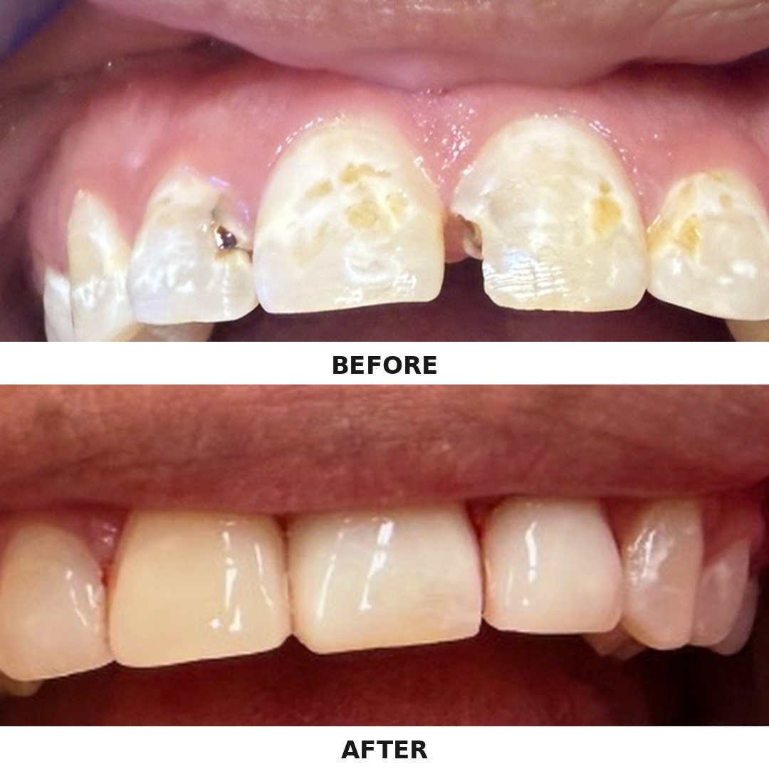 Before and after close-up showing closure of a visible gap between the upper front teeth and restoration of surrounding tooth structure by Dr. Florina Menina at Star Dental in Denver
