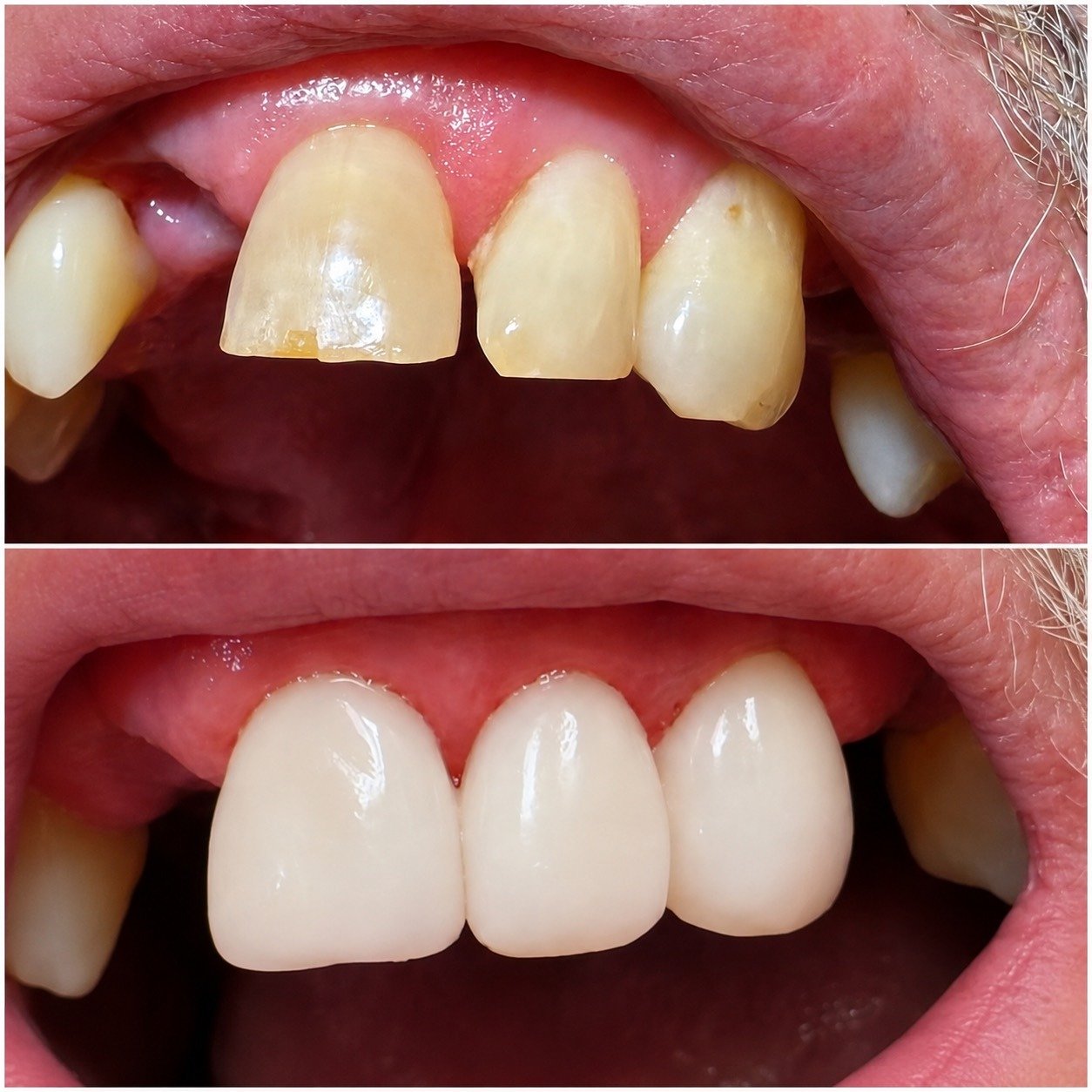 Before-and-after close-up of the upper front-tooth area, with uneven spacing and tooth contours above and a more continuous, uniform appearance below