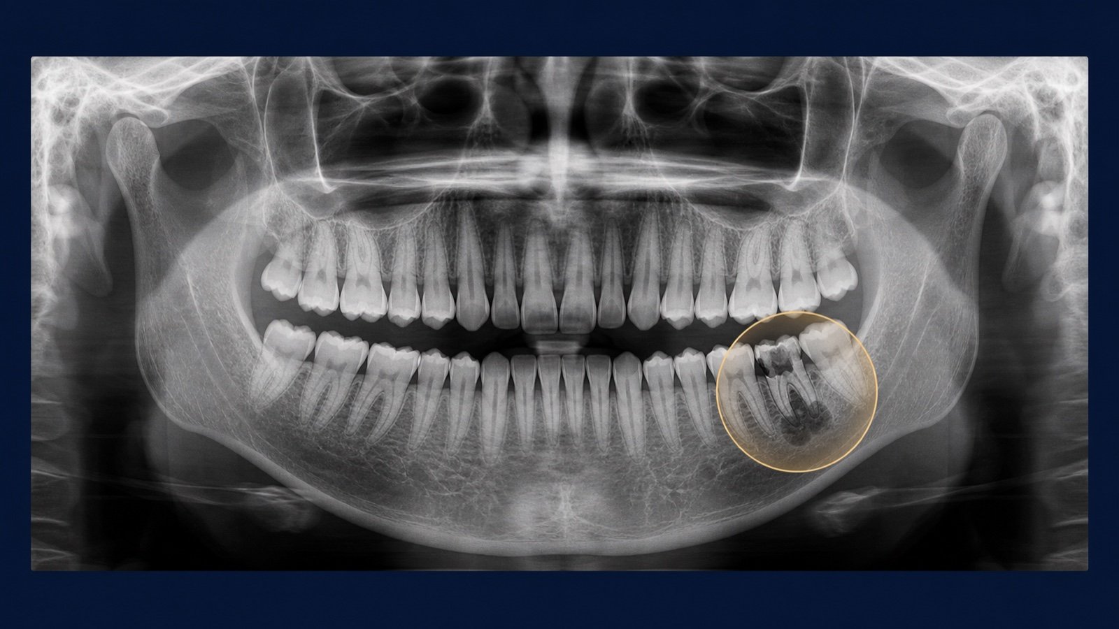 Illustrative panoramic dental radiograph highlighting a severely damaged lower molar