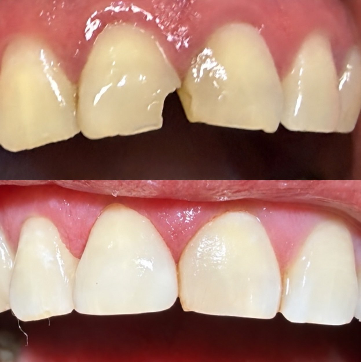 Before-and-after close-up showing a chipped upper front tooth above and its restored contour below