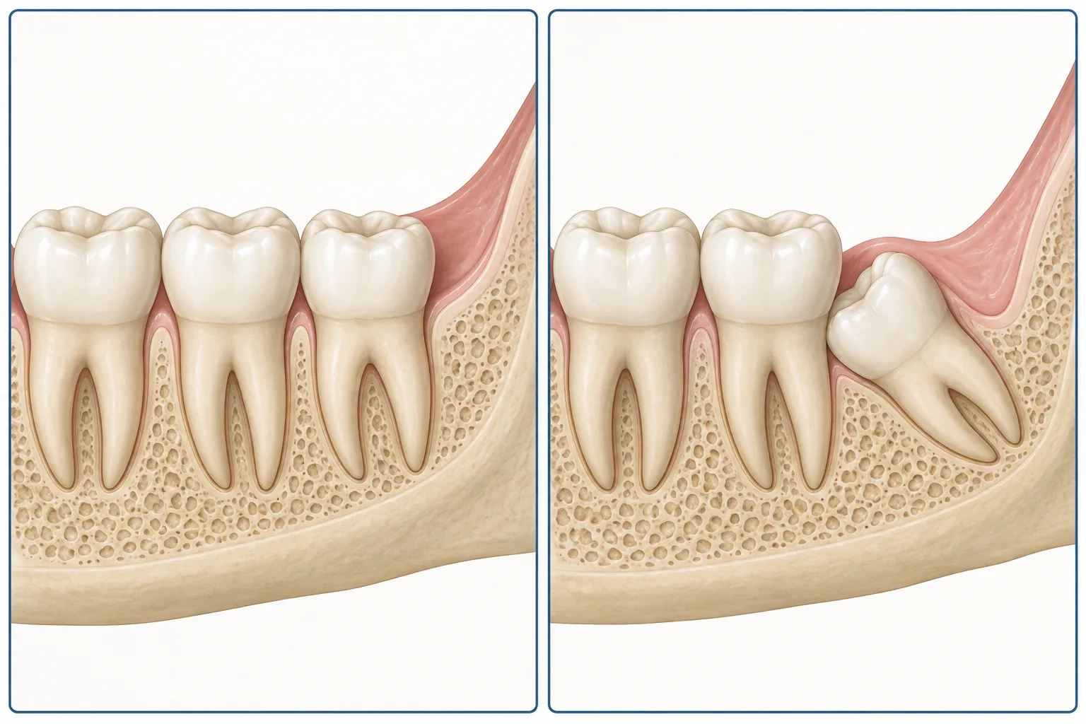 Side-by-side illustrations of an upright wisdom tooth and an angled wisdom tooth partly covered by gum.